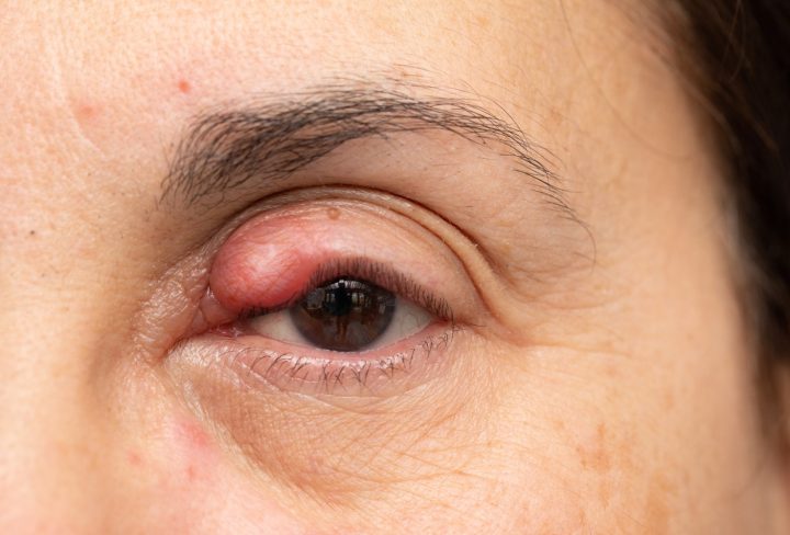 Chalazion 1